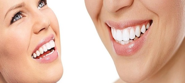 What is the best Teeth whitening System available? Quora