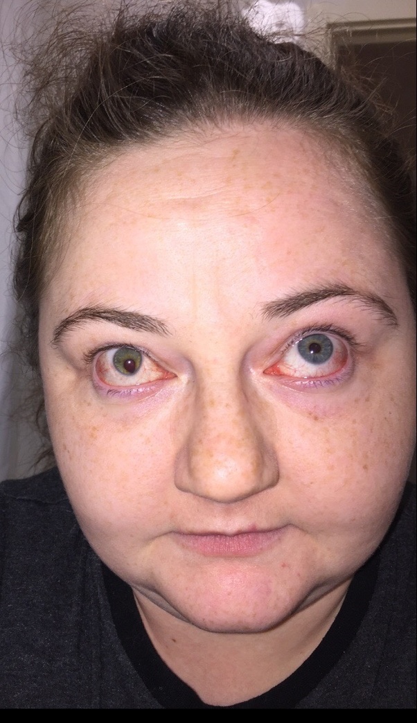 Can someone be born with both Heterochromia Iridum so one