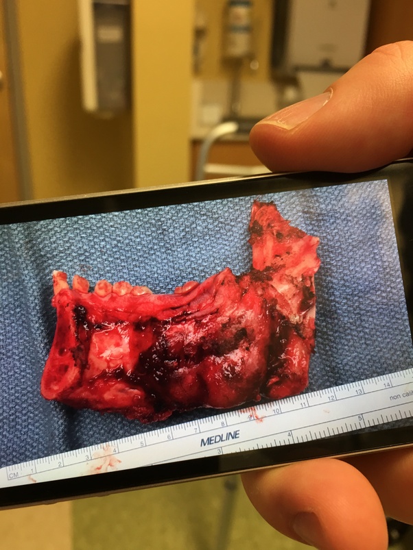 Im having 3 benign tumors removed from my jaw. How long