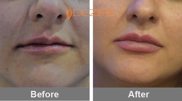 How Long After Lip Injections For Swelling To Go Down