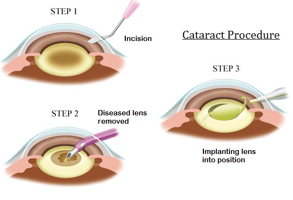 Cataracts Surgery Get Images