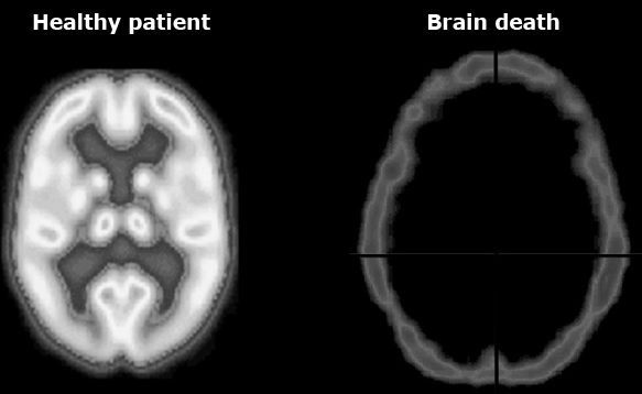 Can the heart work if the brain dies? Quora