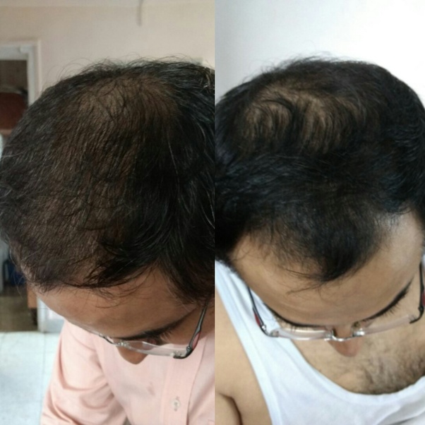 What is the best Hair Loss Treatment For Men in India? Quora