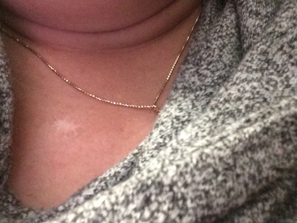 Is it okay that the wound after mole removal formed a