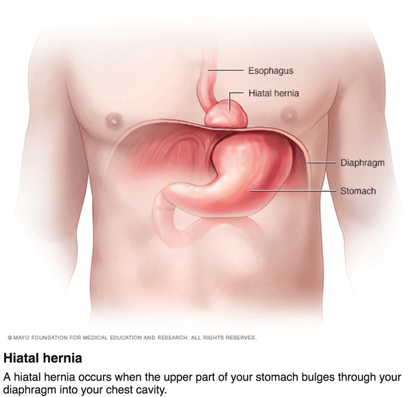 What exactly is a hiatal hernia and can your stomach 'flip' or twist due to this? Quora