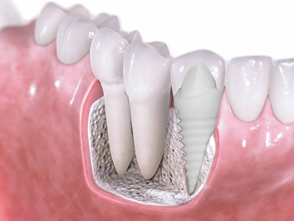 How much does a zirconium tooth implant cost? Quora