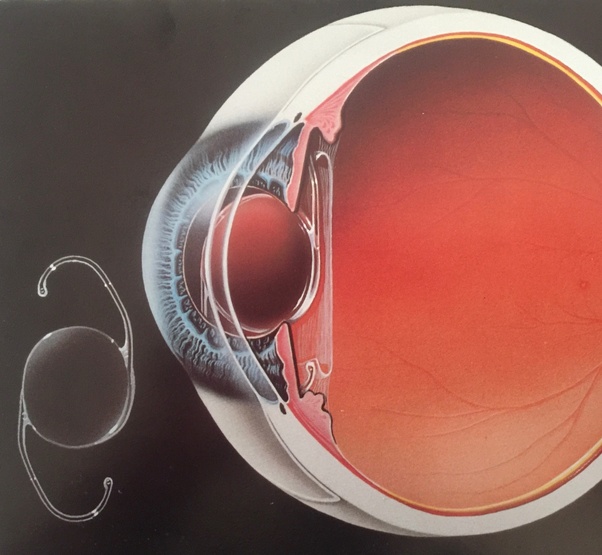 If LASIK didn’t work why would I attempt to improve my