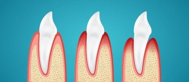 Can I go a night without washing my teeth? Quora