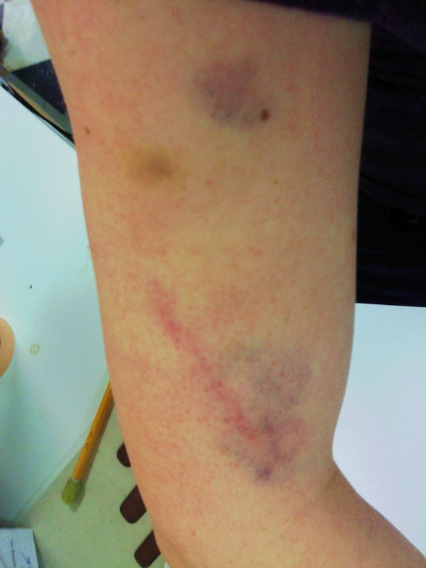 Is fencing considered a contact sport? Quora