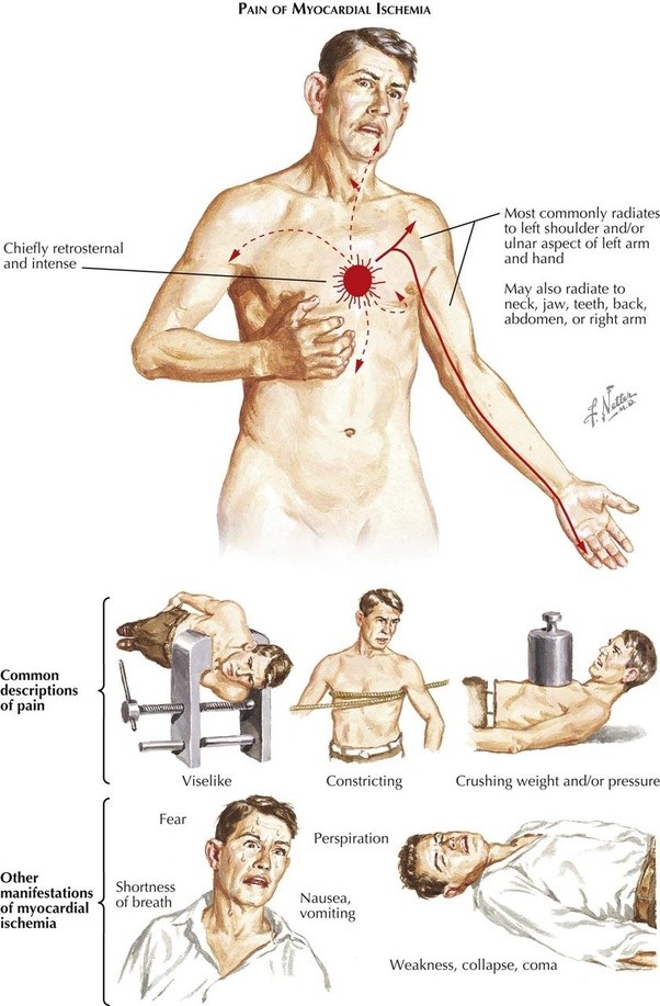 What is it like to see someone having a heart attack? Quora