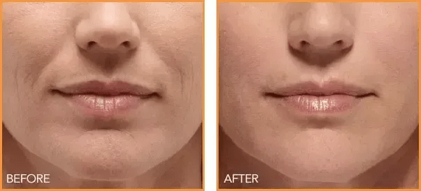 How to get rid of hereditary eye bags Quora