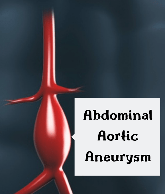 What are the symptoms of an abdominal aortic aneurysm? Quora