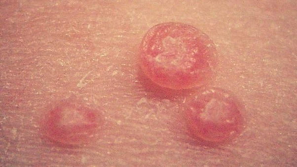 Once you get an STD can you get rid of it? Quora