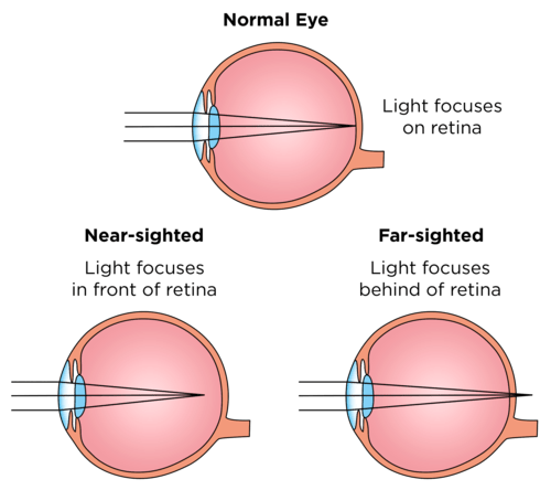 A person suffering from hypermetropia wants to read his book. Should he