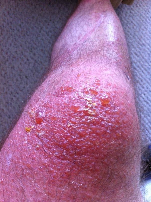 How does poison oak/ivy cause its effects on the body? Quora