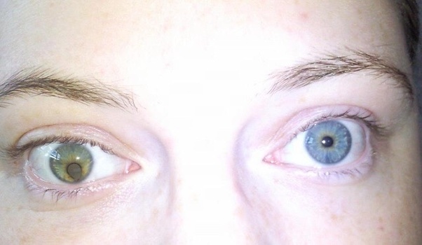 Can someone be born with both Heterochromia Iridum so one