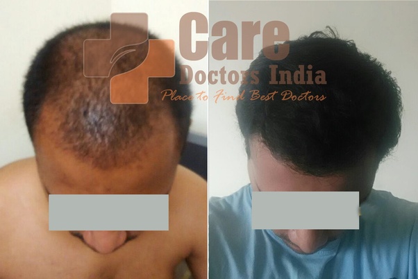 How much does it cost to get hair transplant in Australia? Quora