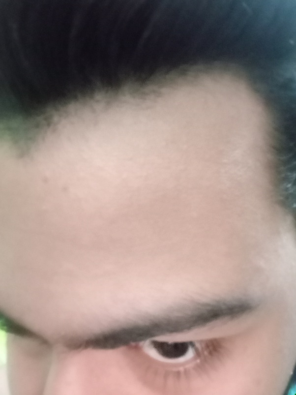 How does it feel going bald or having hair loss at a young