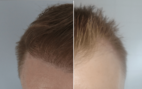 How Long Before Strip To Heal Hair Transplant FUT?