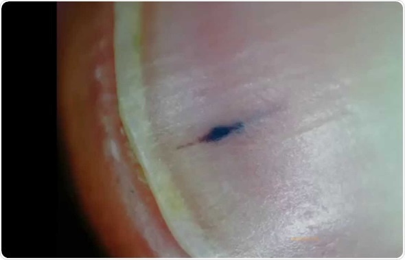 Why does a person have black spots on their nails that always change