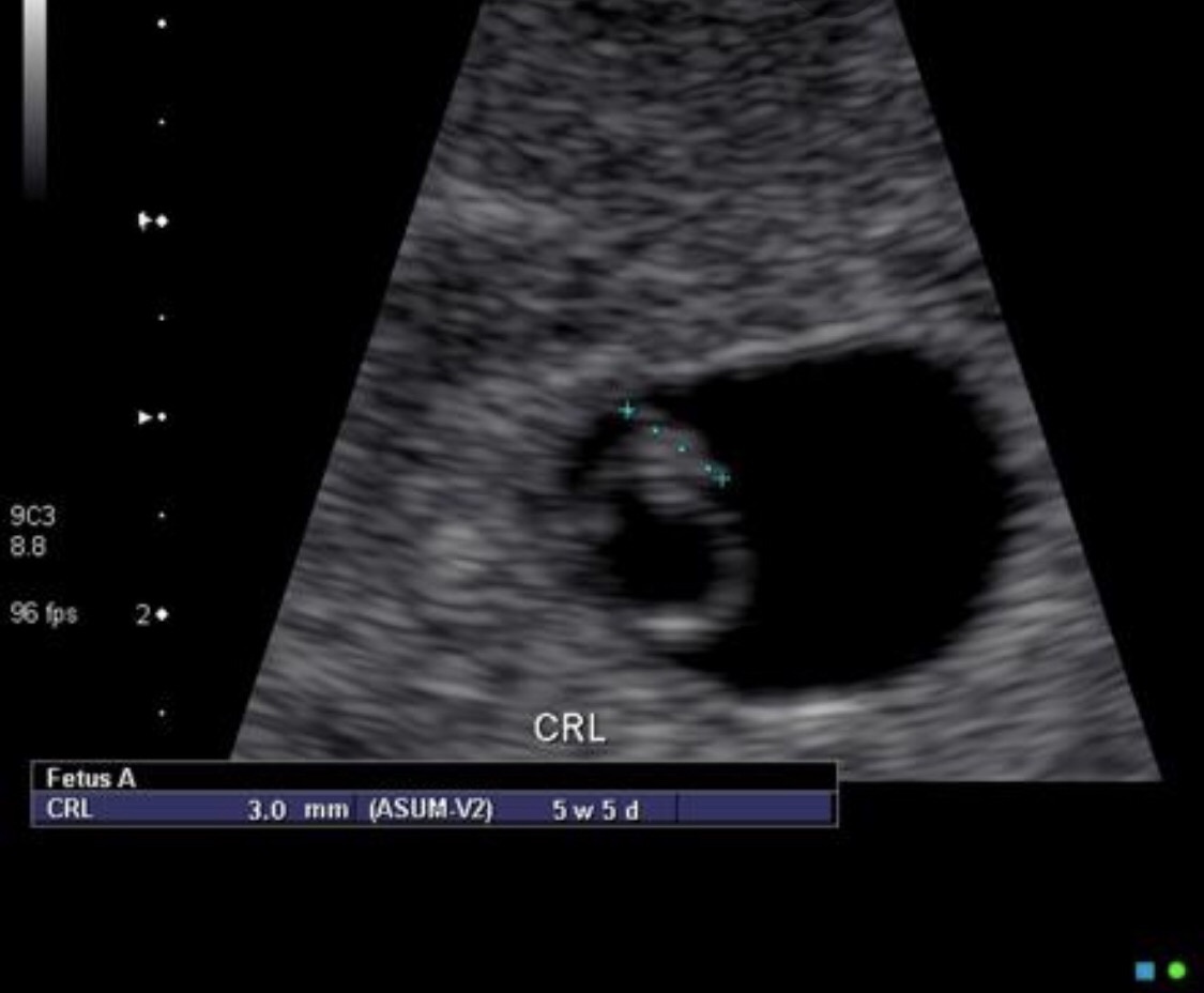 6 Week Pregnancy Scan - | 6 Week Ultrasound | 6 Week Scan | 6 Week Scan Photo International Ultrasound Services What Would An Ultrasound Show At 4 Weeks Of Pregnancy? - Quora