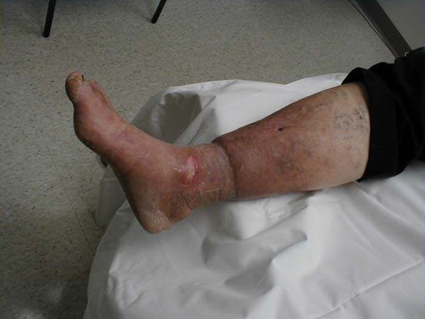 What causes discoloration and swelling in the legs of diabetics? Quora