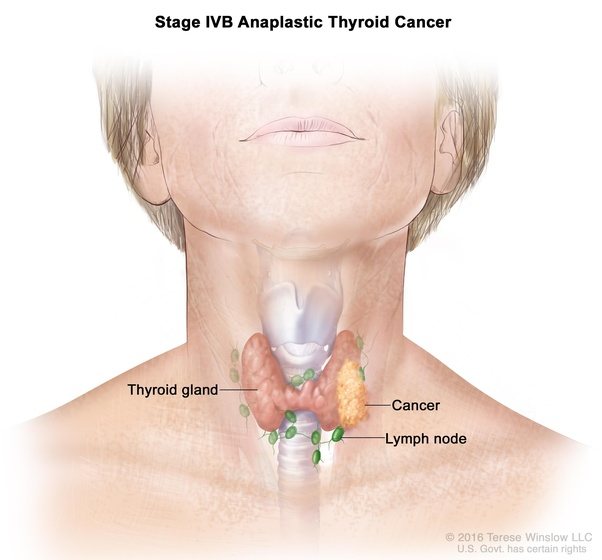What Are The characteristics of Anaplastic thyroid Cancer? Quora