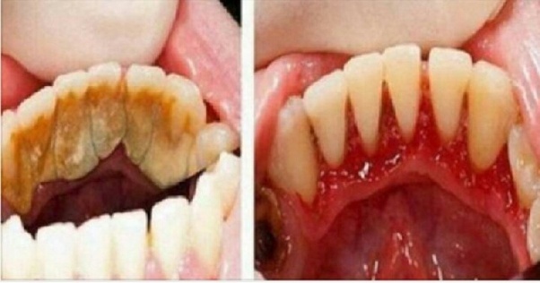 Are dentists really that popular? How Long Should A Typical Dental Cleaning To Take Quora