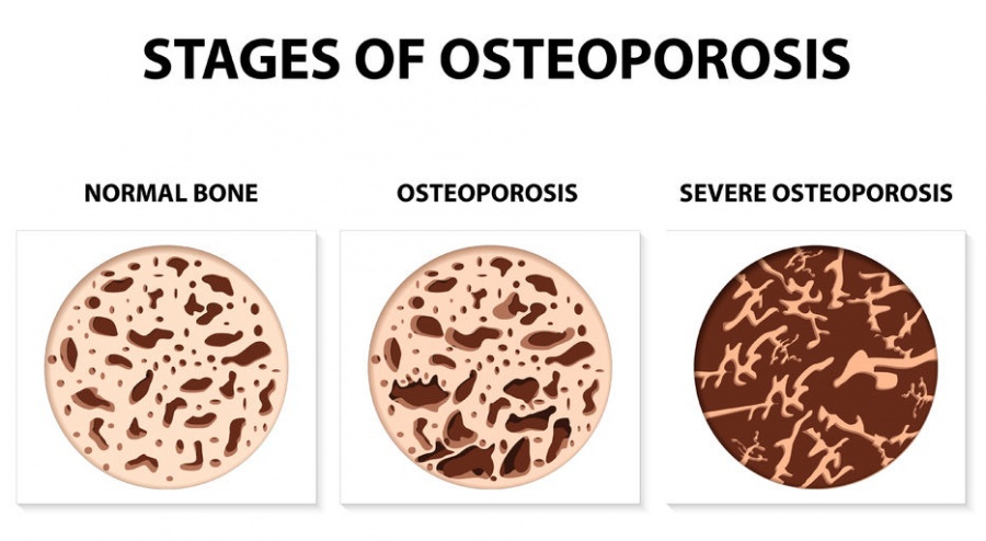 Apa itu osteoporosis? - Quora