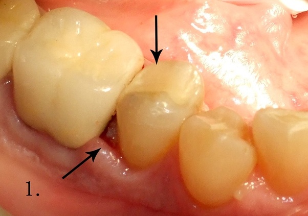 Why does the gum between my tooth hurt? I had meat stuck between my