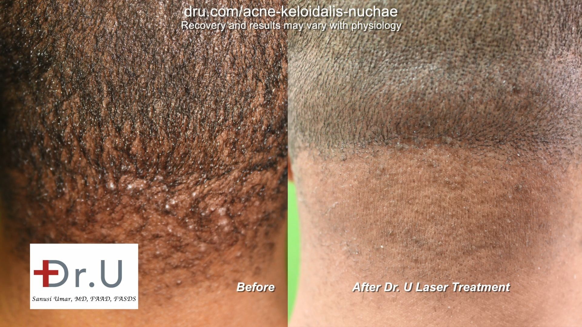 Razor Bumps After Haircut hairstyle how to make