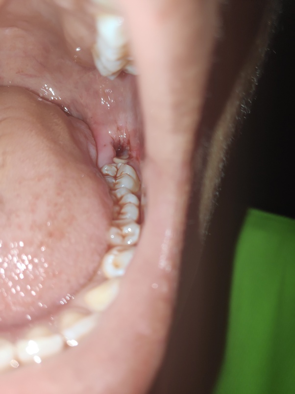 Why is there a leftover teeth after wisdom teeth extraction? (Please