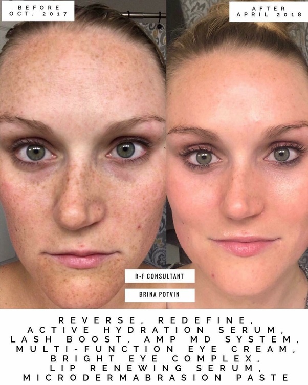 How to get rid of my freckles Quora