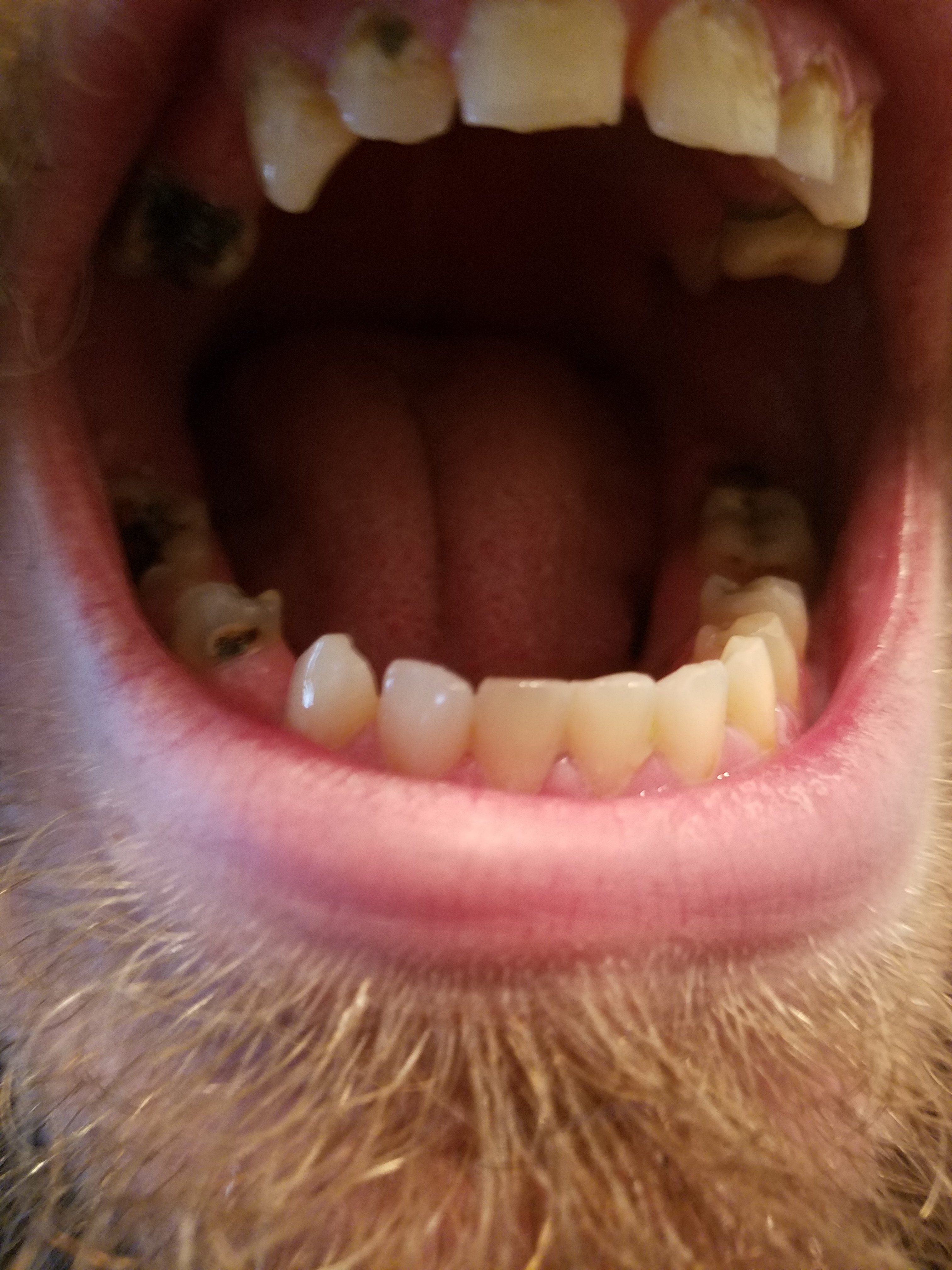 Cavity filling types, procedure, pain & aftercare
