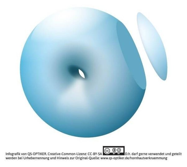 What does 0.75 eye cylinder mean? Quora