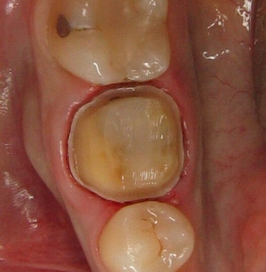 How often do dental crowns fall out? Quora
