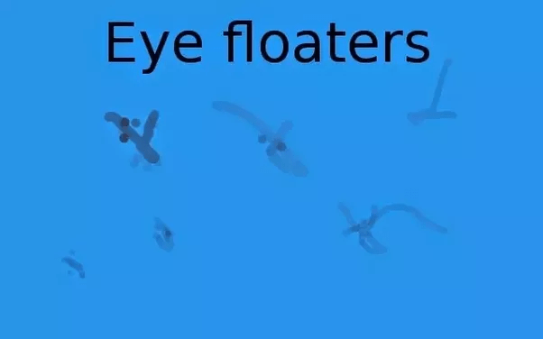 What do black squiggly lines in the vision indicate? Quora