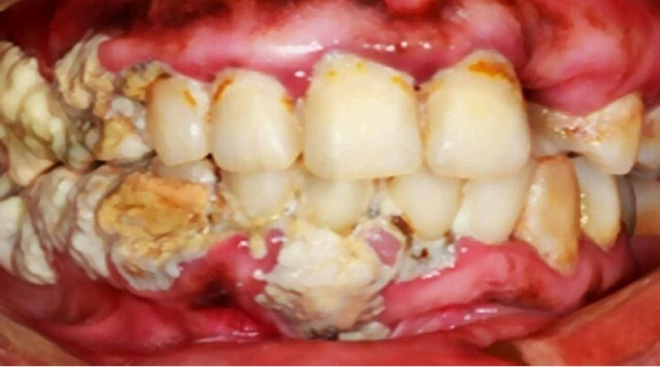 How Regularly Should You Get Your Teeth Cleaned? Healthline