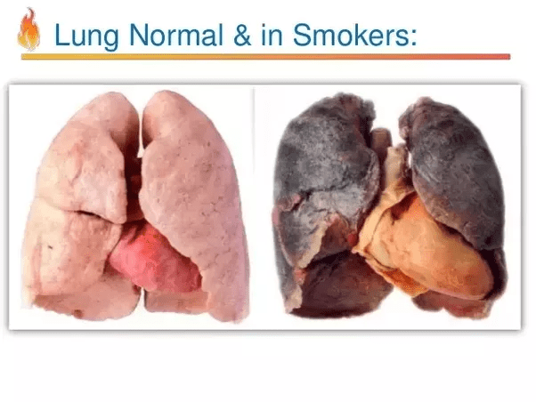 Copd Quora COPD Blog c