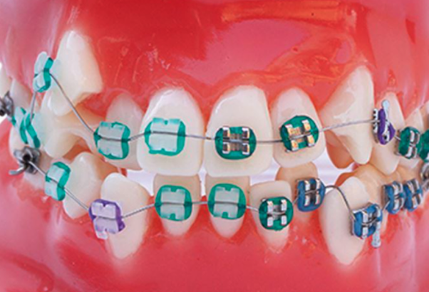How To Get Rid Of Your Braces Pain / 15 Must Knows About Braces For