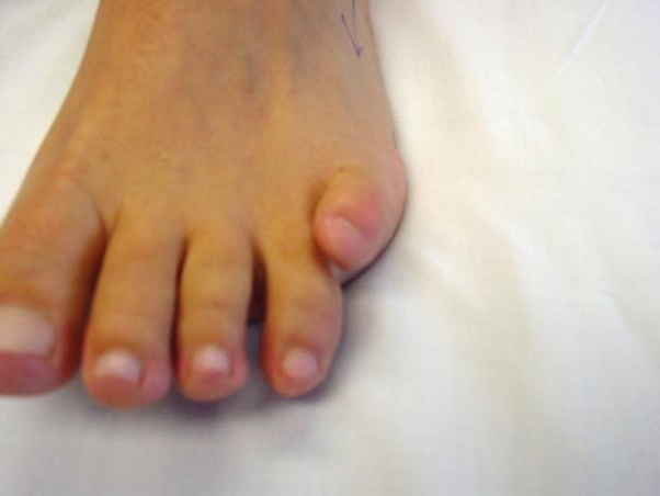 Why do some people have pinky toes that don’t touch the ground? Is