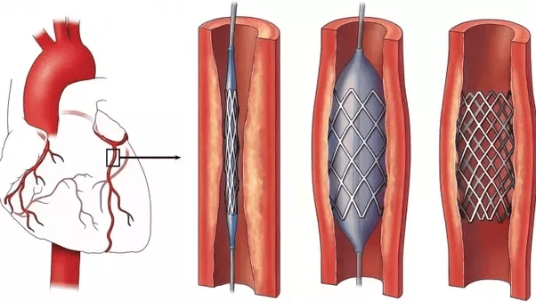 What is a stent? Quora