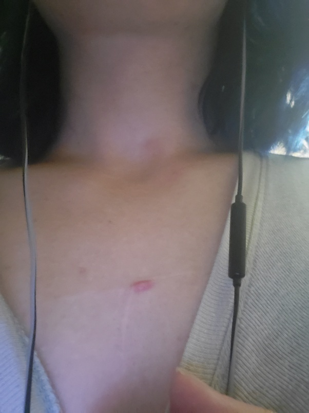 What do your self harm scars look like? Quora