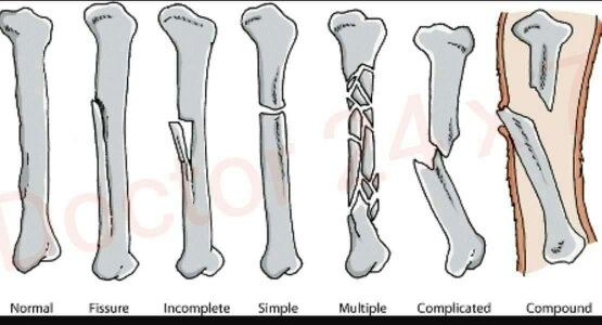 How does a simple fracture and a compound fracture differ? Quora