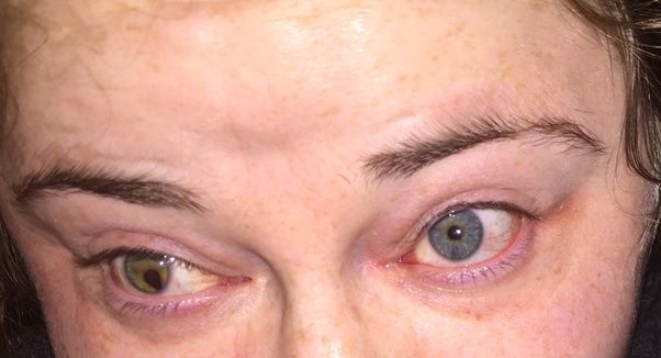 Can two browneyed people have a blueeyed child? Quora