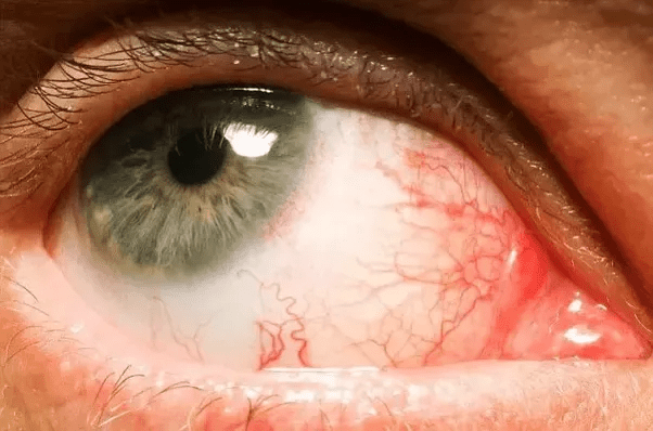 Why do my eyes hurt when I don't get enough sleep? Quora