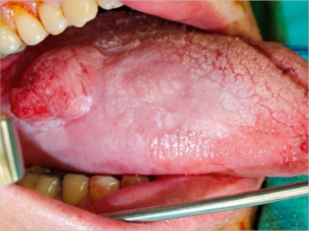 What is the early stage mouth cancer symptoms? Quora