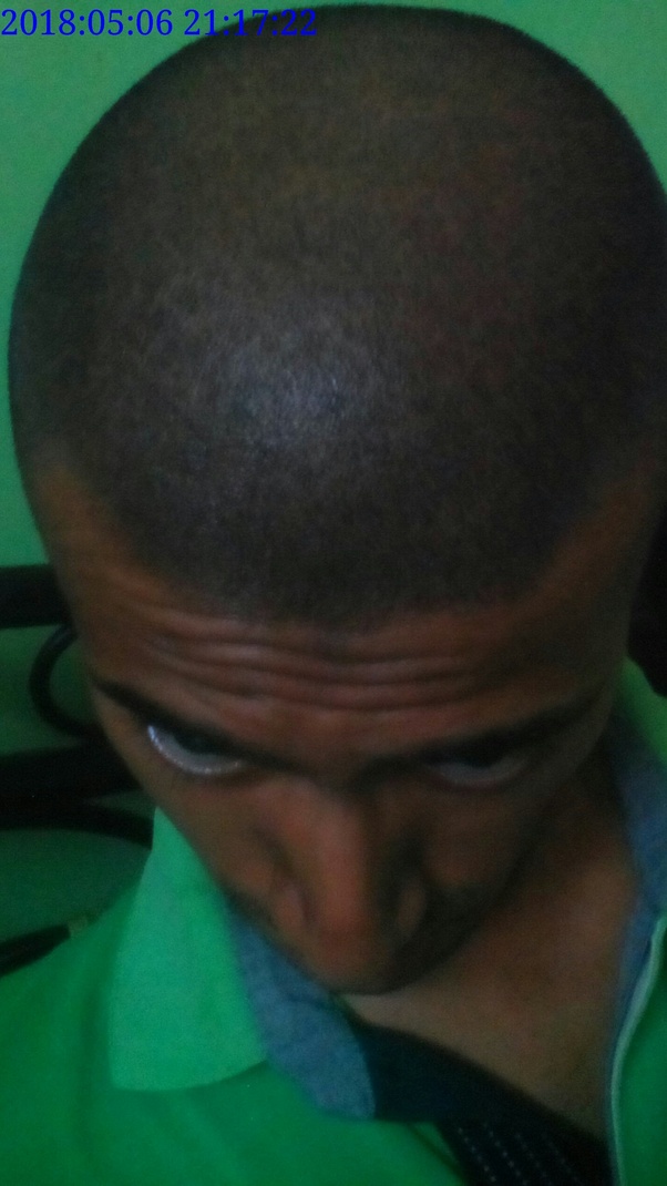 How long does it take to grow hair after a person has