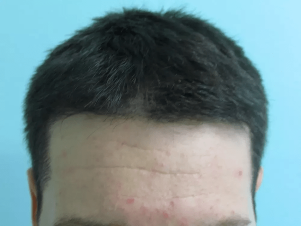 How much is the hair density important for the hair transplant? Quora
