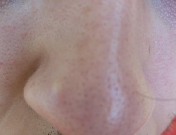 What is this bump on my nose? Quora